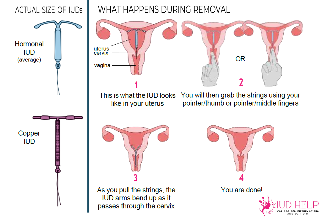 IUD Self Removal Graphic